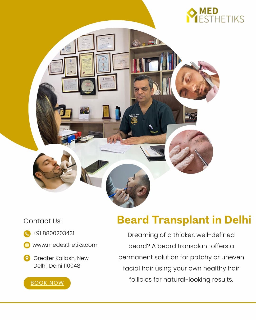 Photo shared by Med Esthetiks: ✨ Beard Transplant in Delhi | Natural, Fuller Beard Results