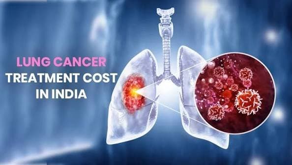 Photo shared by HOSPIDIO: Lung Cancer Treatment Cost in India – Get Treatment Options & Cost | HOSPIDIO
Planning lung cancer 