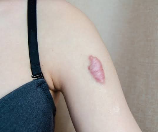 Photo shared by Anew Cosmetic: Keloid scars are raised, thick scars that grow beyond the original wound due to excess collagen prod