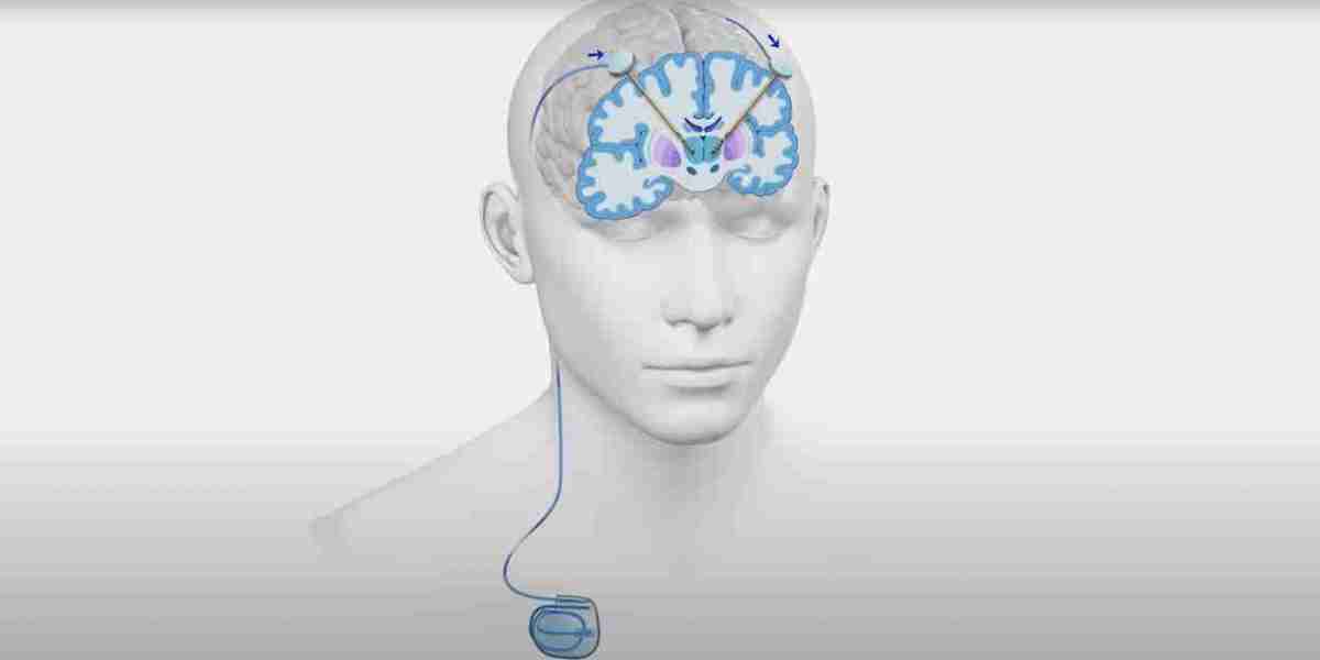 Deep Brain Stimulation Surgery: A Revolution in Treating Neurological Disorders