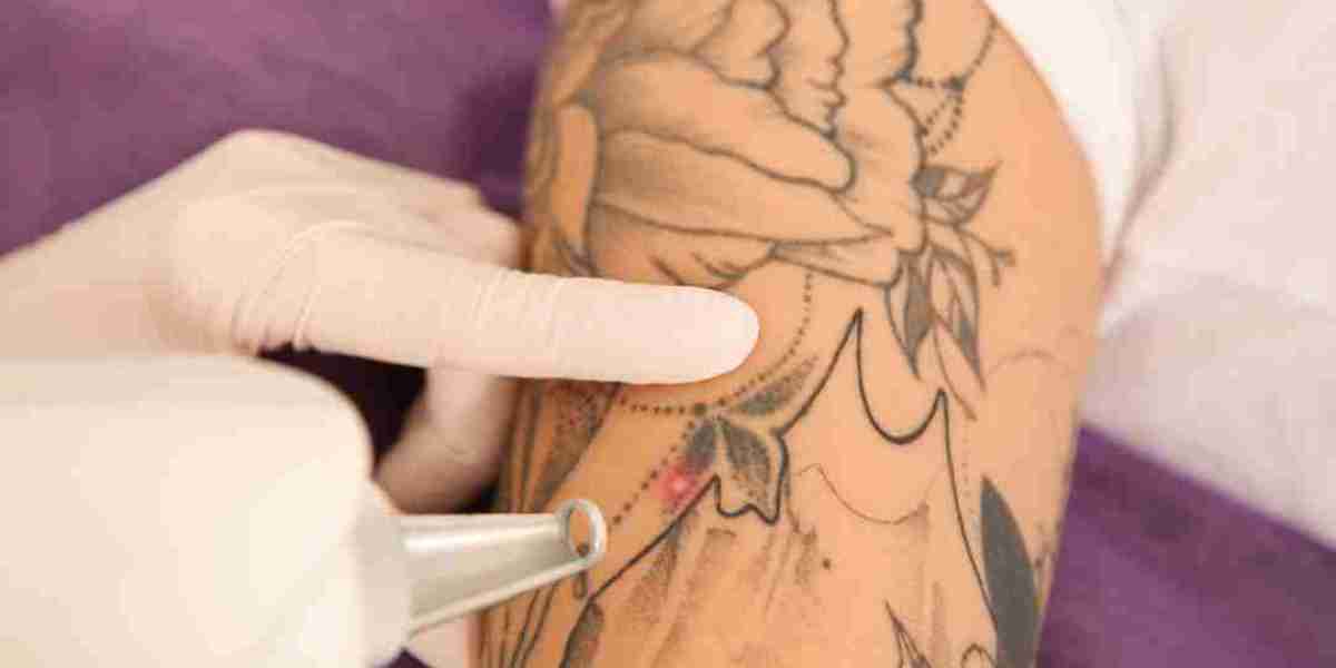 How Permanent Laser Tattoo Removal Helps You Achieve Clear Skin in Dubai